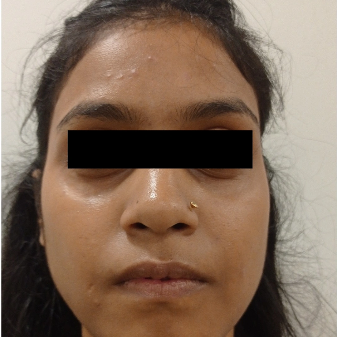glutathione injection cost in hyderabad What is the Hyperpigmentation Treatment Cost in Hyderabad? main image 0