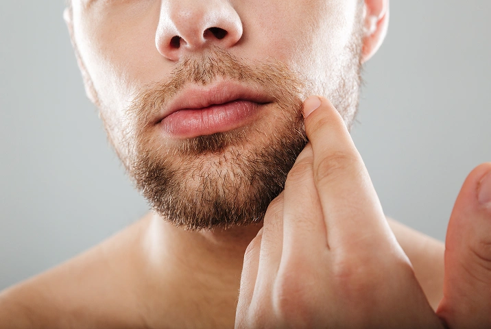 Beard & Mustache Hair Transplant | Beard Transplant Price